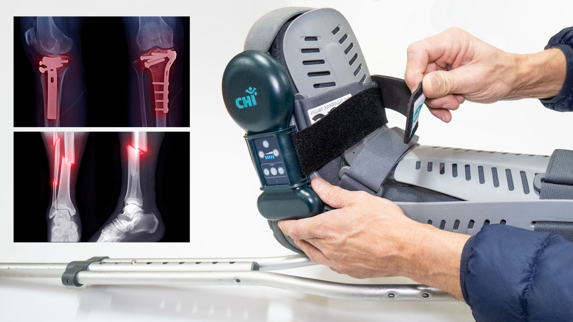 CHI Bone Fracture Clinic