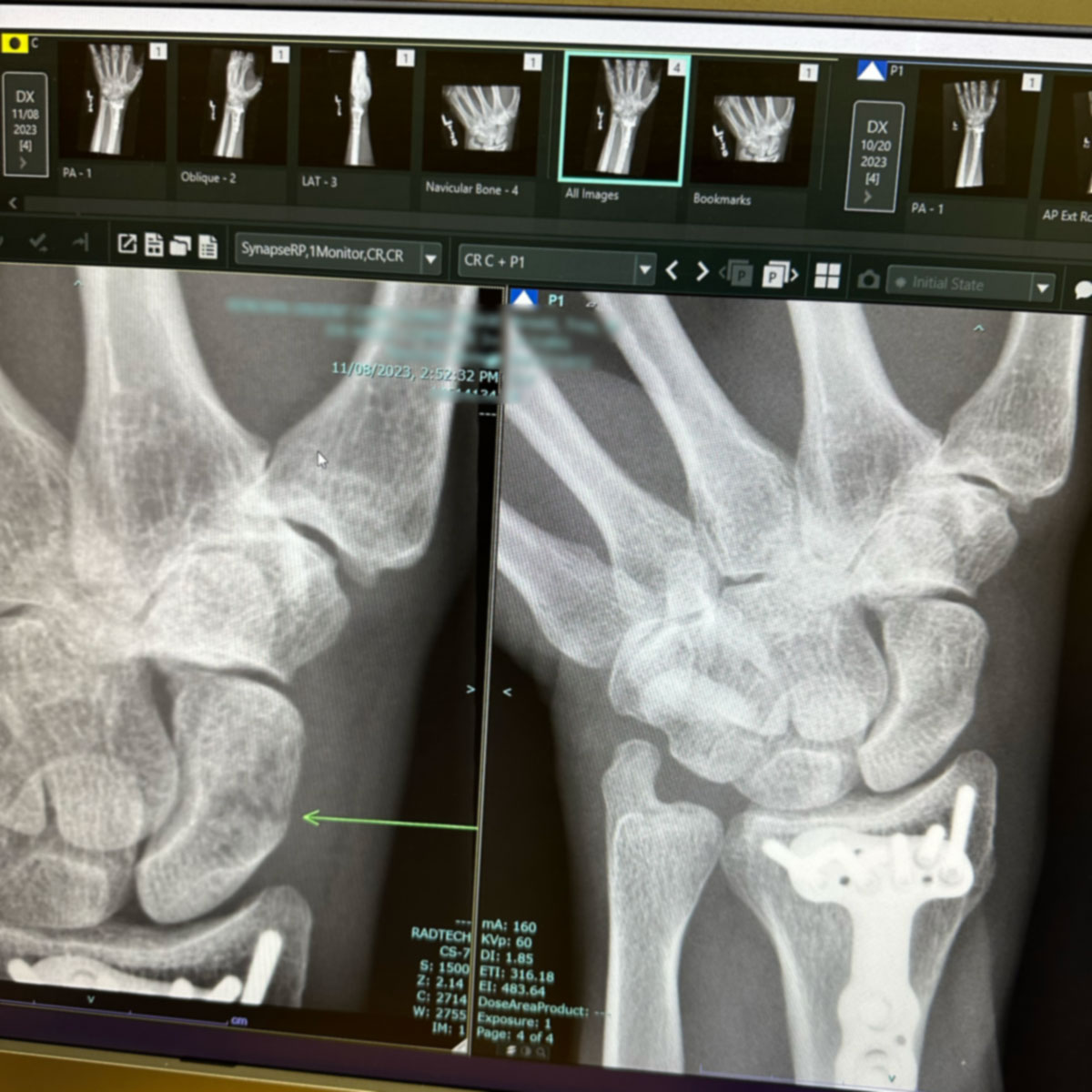 X-Ray Fractured Scaphoid