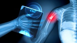CHI Palm Accelerates Healing of Fractures