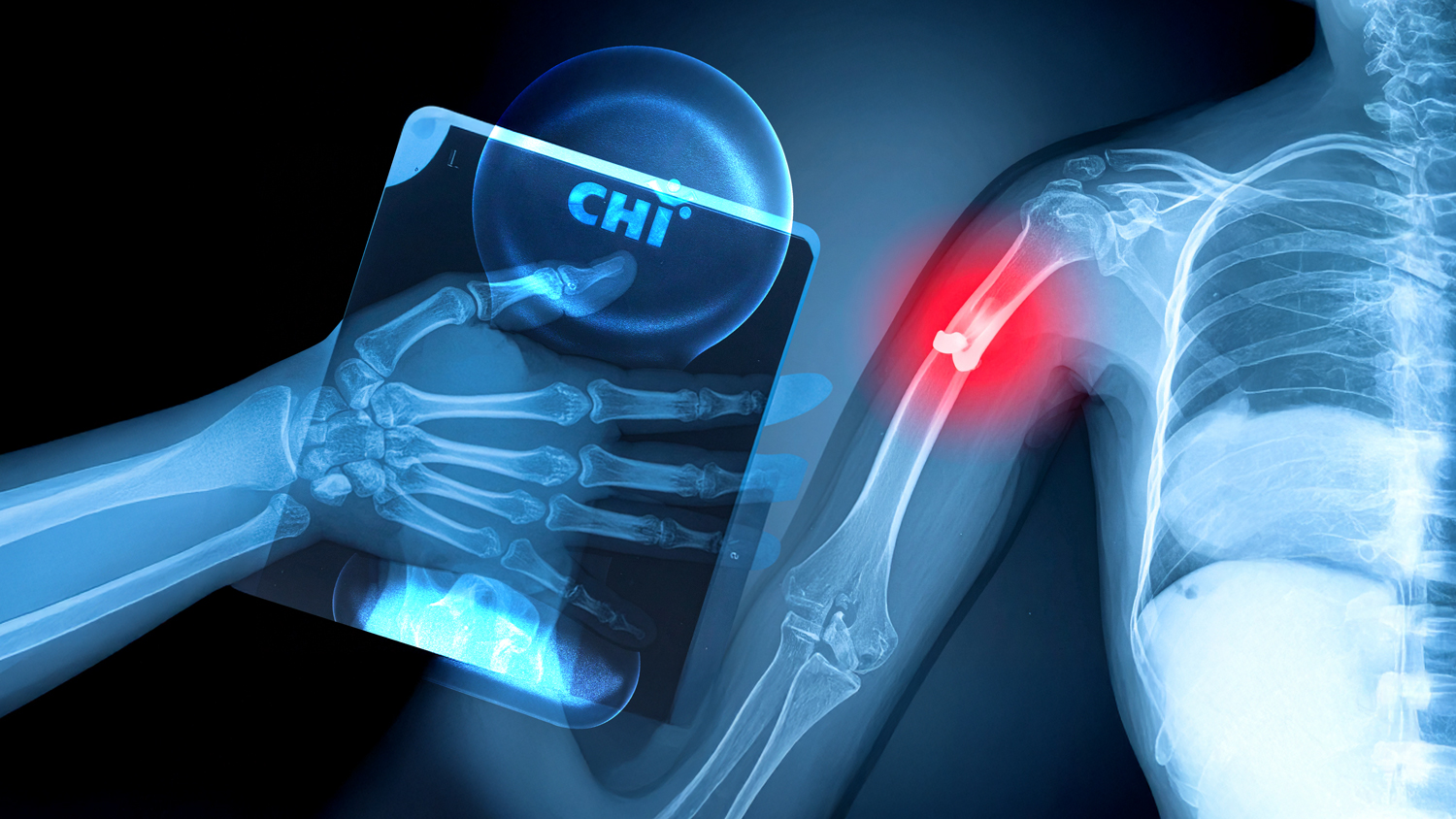 CHI Palm Accelerates Healing of Fractures