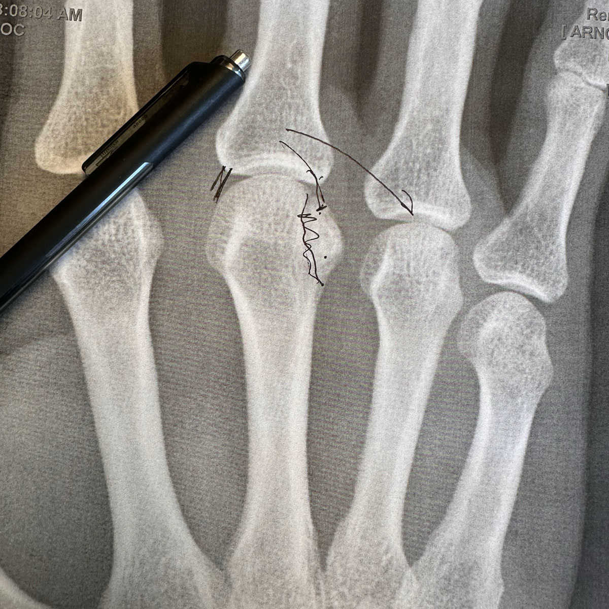 Troy's Fractures