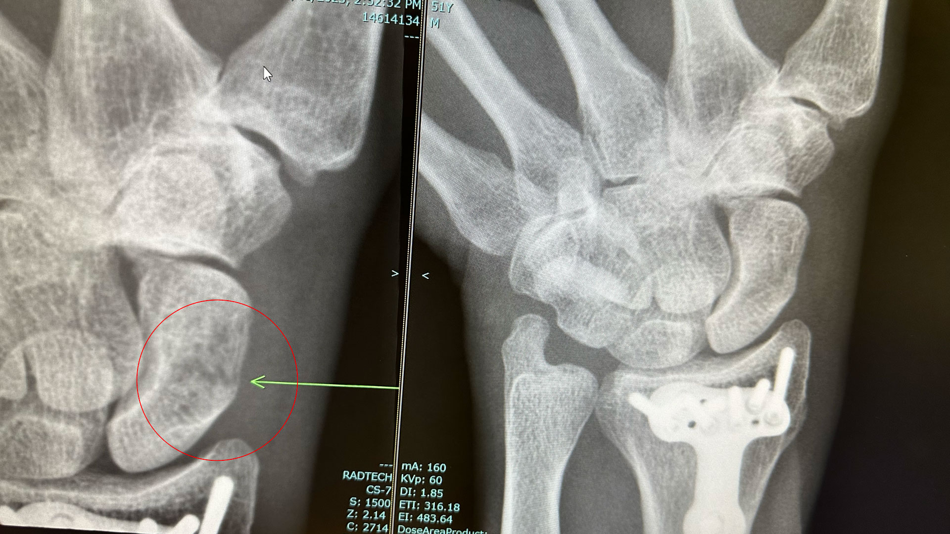 Troy's Fractures