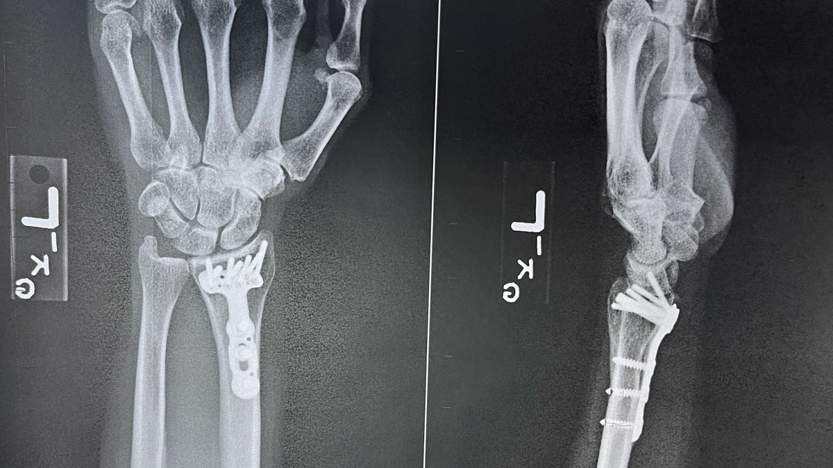 Troy's Fractures