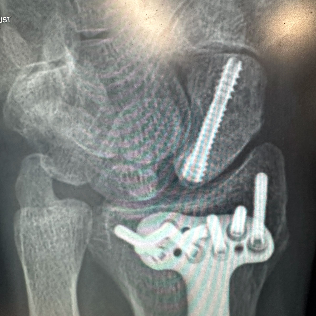 Troy's Fractures